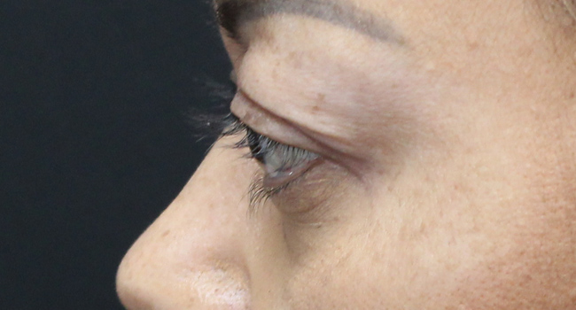 Case--4723 | Before Face 5