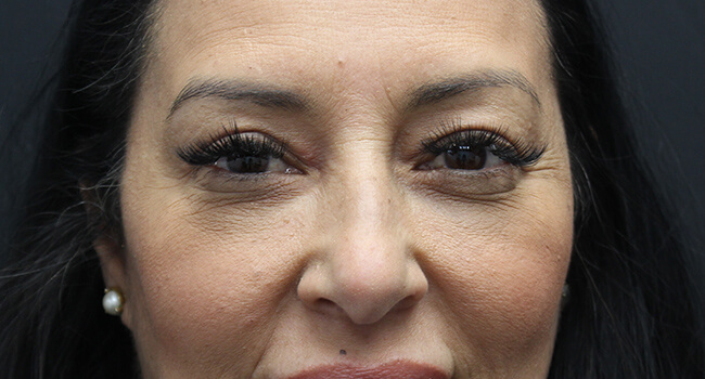 Case--1001 | After Blepharoplasty 1