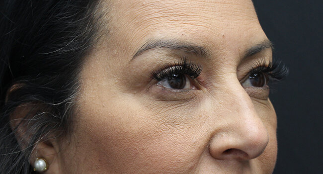 Case--1001 | After Blepharoplasty 2