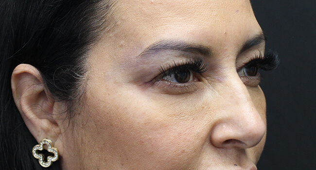 Case--1001 | Before Blepharoplasty 2
