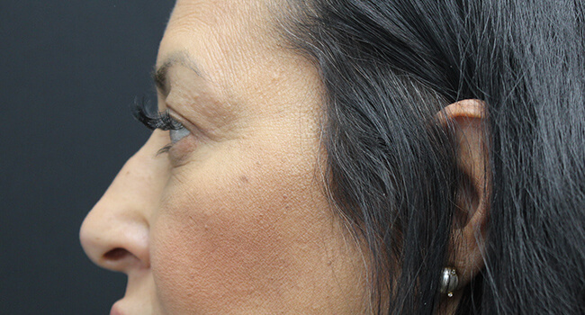 Case--1001 | After Blepharoplasty 3