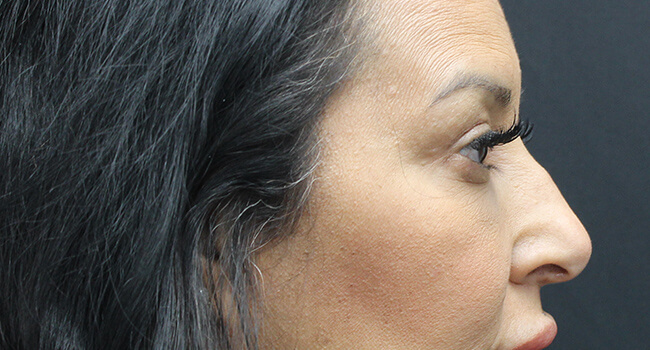 Case--1001 | After Blepharoplasty 5