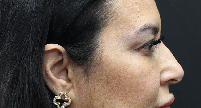 Case--1001 | Before Blepharoplasty 5