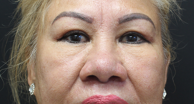 Case--3343 | After Blepharoplasty 1