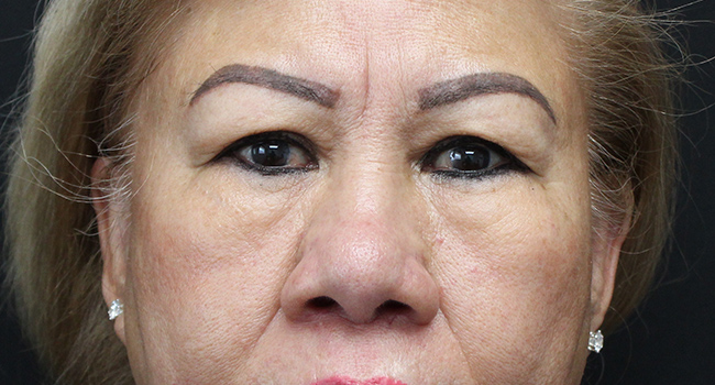 Case--3343 | Before Blepharoplasty 1