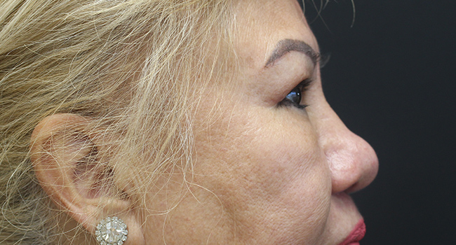 Case--3343 | After Blepharoplasty 2