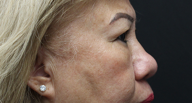 Case--3343 | Before Blepharoplasty 2