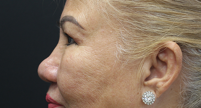 Case--3343 | After Blepharoplasty 3