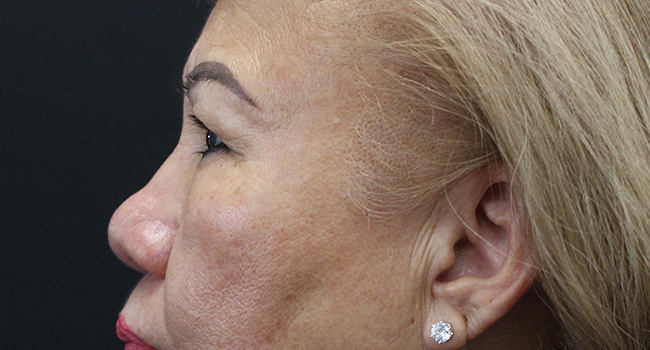 Case--3343 | Before Blepharoplasty 3