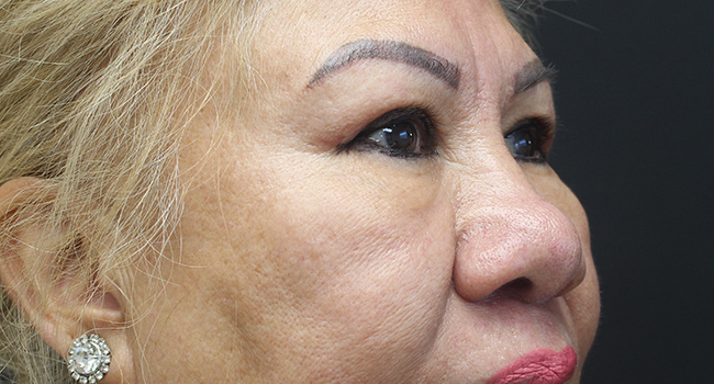 Case--3343 | After Blepharoplasty 4