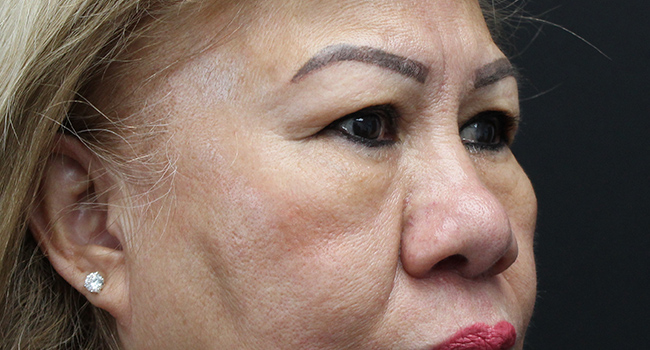 Case--3343 | Before Blepharoplasty 4