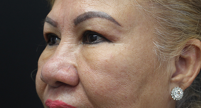 Case--3343 | After Blepharoplasty 5