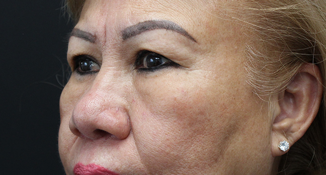 Case--3343 | Before Blepharoplasty 5
