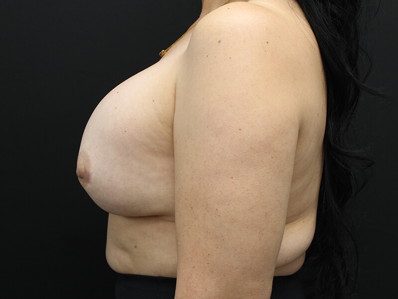 Case--8011 | Before Breast Augmentation 3