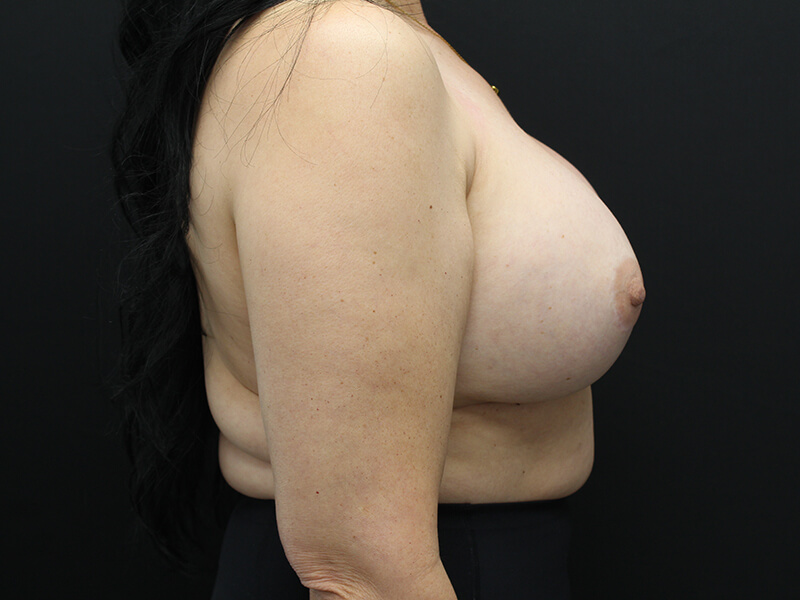 Case--8011 | After Breast Augmentation 5