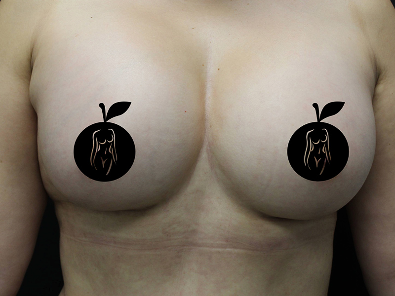 Case--9840 | After Breast Augmentation 1