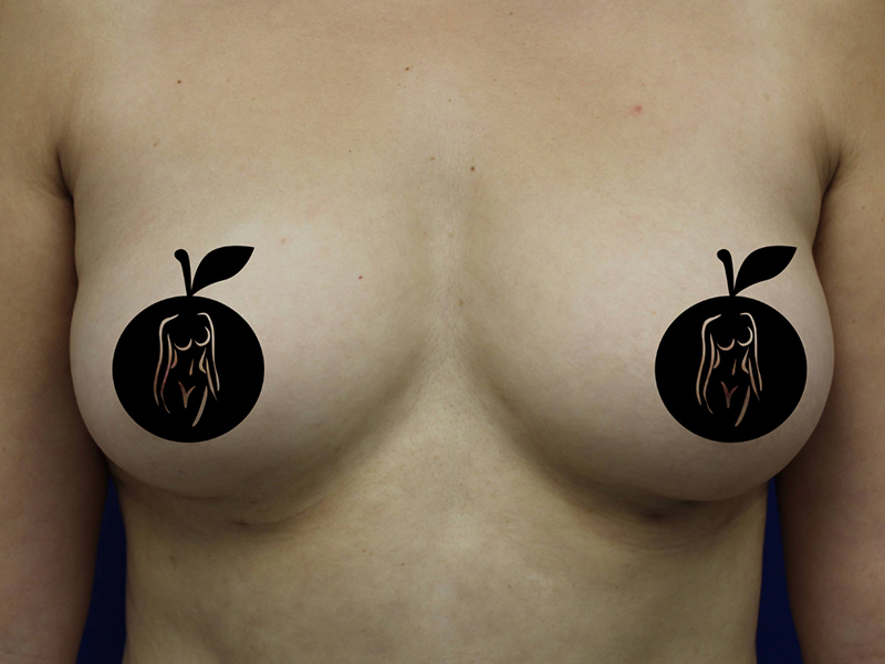 Case--9840 | Before Breast Augmentation 1