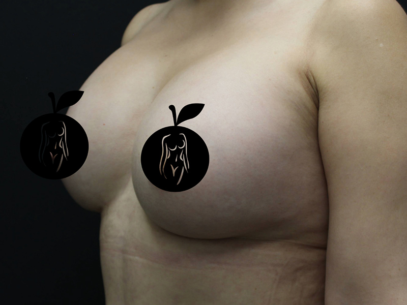 Case--9840 | After Breast Augmentation 2