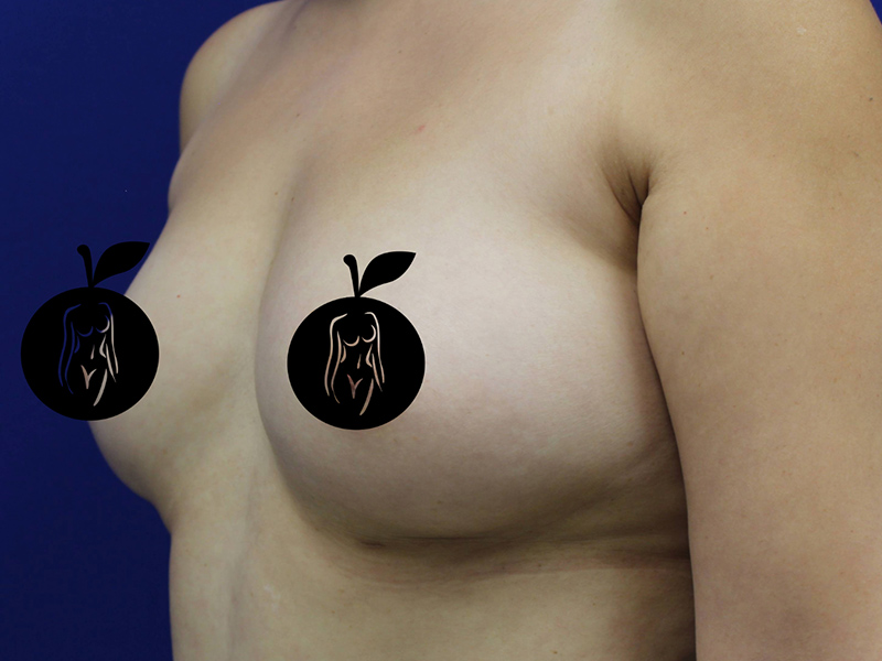 Case--9840 | Before Breast Augmentation 2