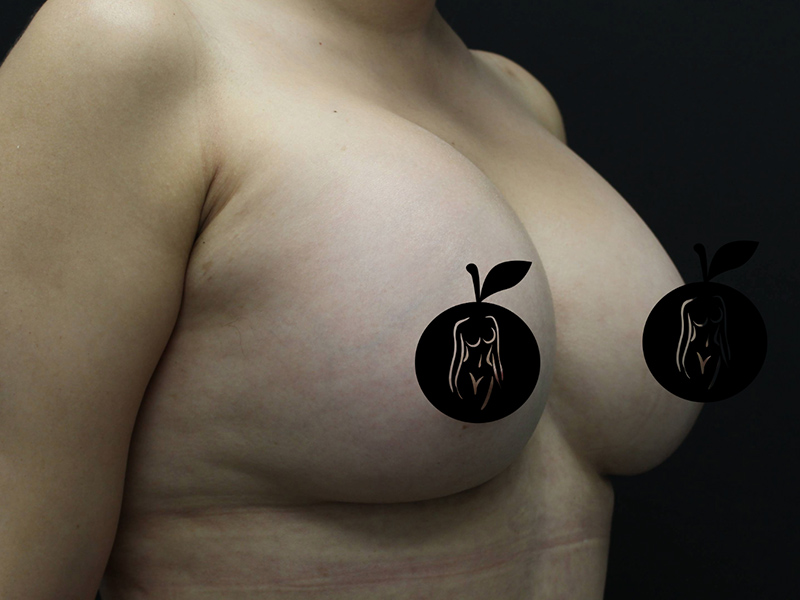 Case--9840 | After Breast Augmentation 3