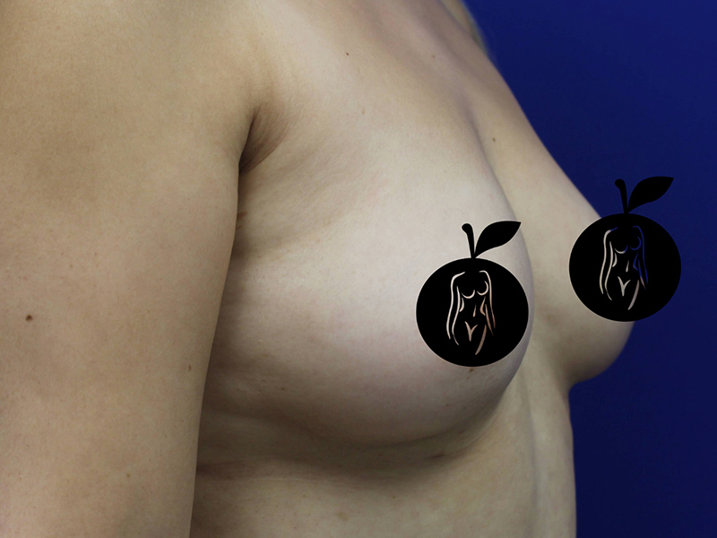Case--9840 | Before Breast Augmentation 3