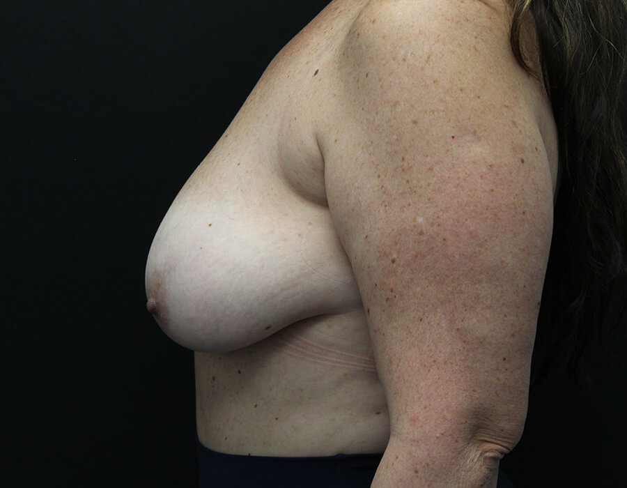 Case--3690 | Before Breast Reduction 3