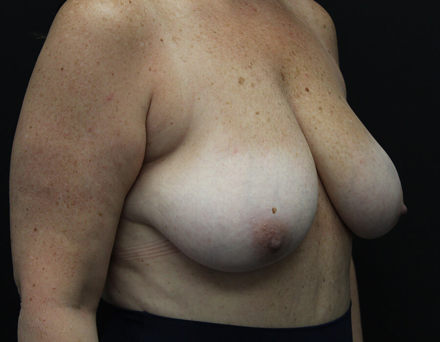 Case--3690 | Before Breast Reduction 4