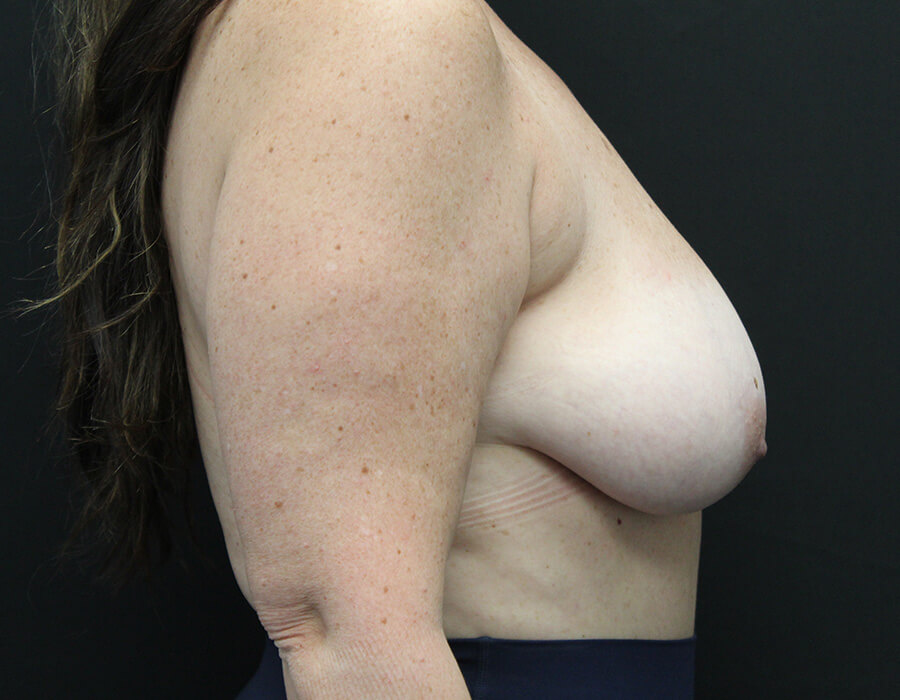 Case--3690 | Before Breast Reduction 5
