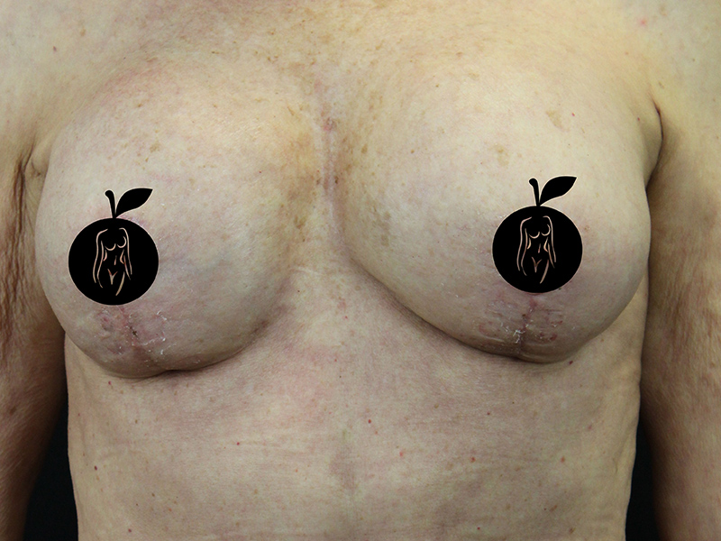 Case--1732 | After Breast Lift 1