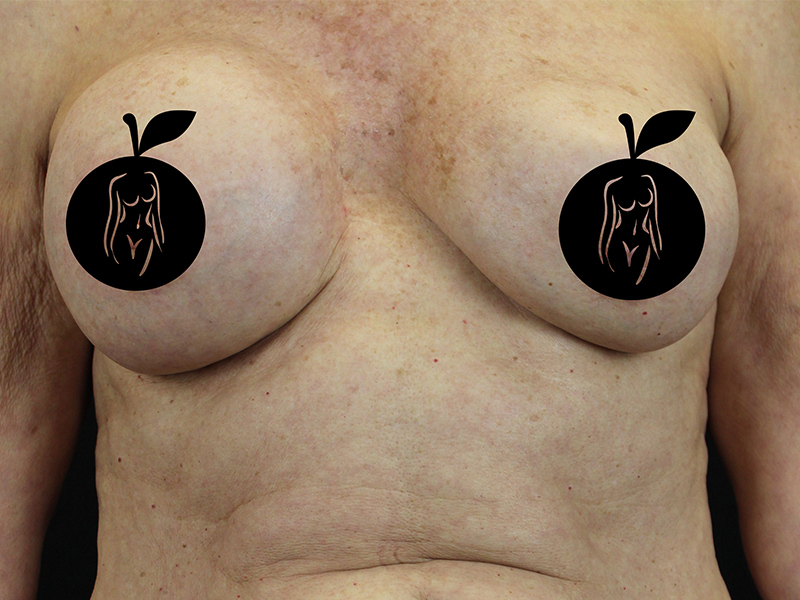 Case--1732 | Before Breast Lift 1