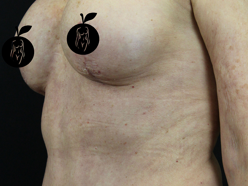 Case--1732 | After Breast Lift 2