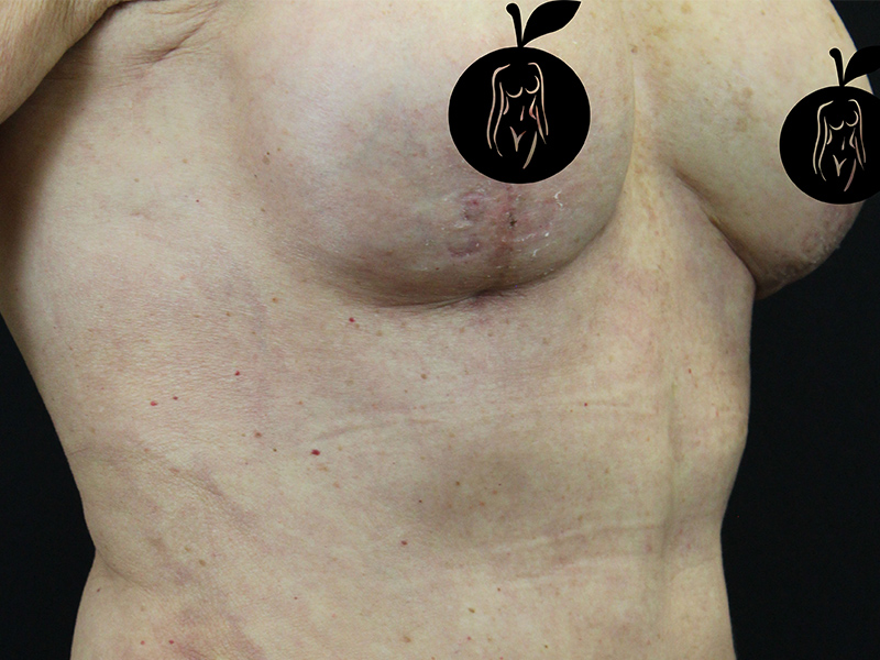 Case--1732 | After Breast Lift 3