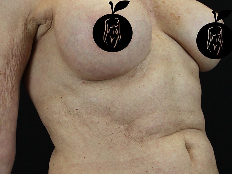 Case--1732 | Before Breast Lift 3
