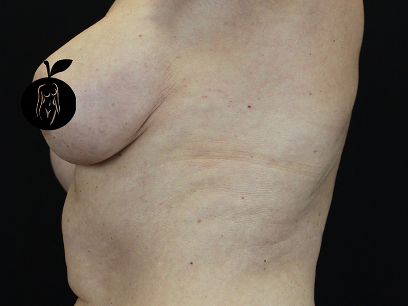 Case--1732 | Before Breast Lift 4