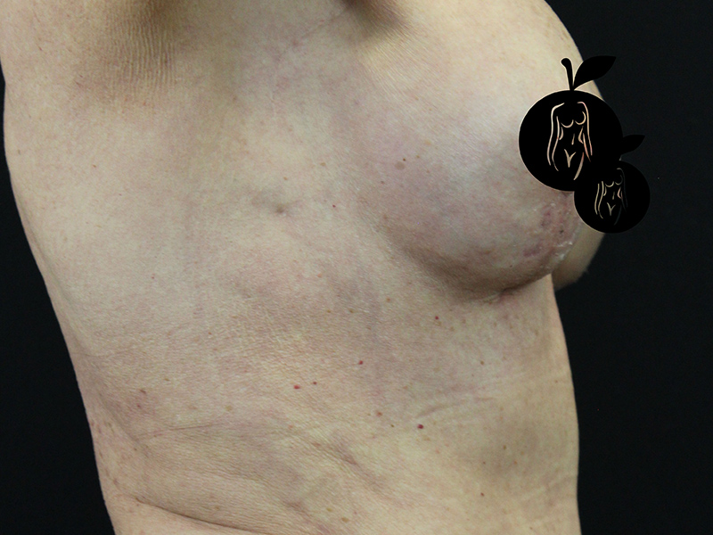 Case--1732 | After Breast Lift 5