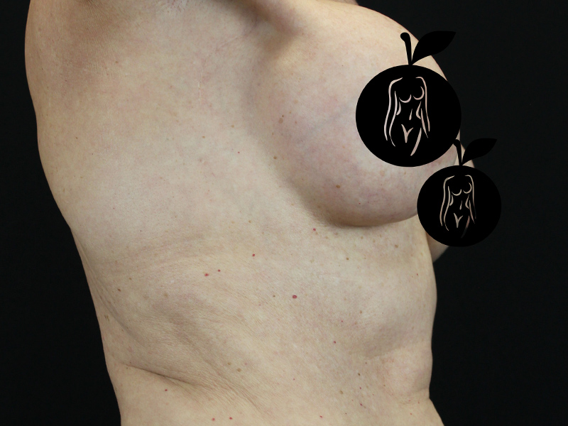 Case--1732 | Before Breast Lift 5