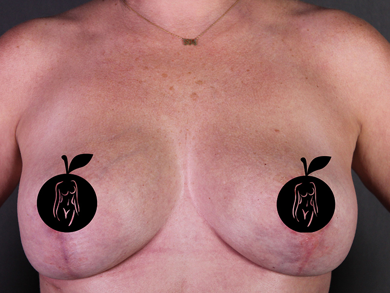 Case--4524 | After Breast Lift 1