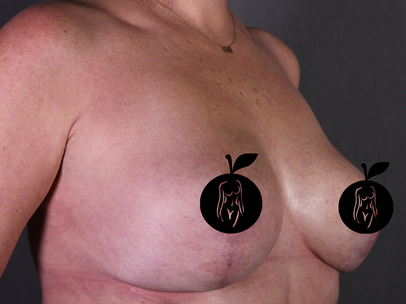 Case--4524 | After Breast Lift 5