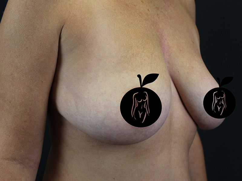 Case--4524 | Before Breast Lift 5