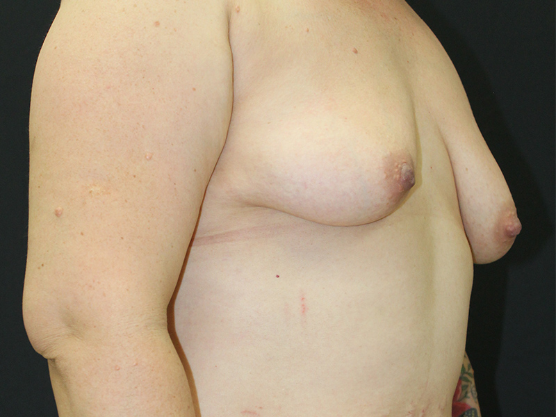 Case--5402 | Before Breast Lift 3