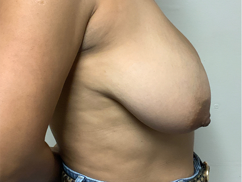 Case--2353 | Before Breast Reduction 4