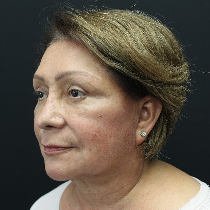 Case--3137 | After Face 4