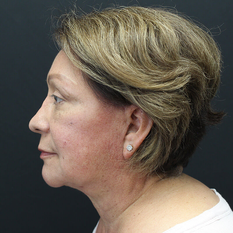 Case--3137 | After Face 5