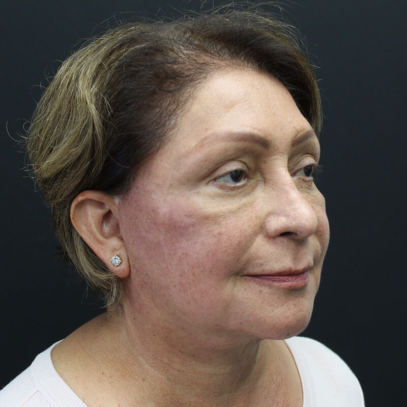 Case--3137 | After Face 2