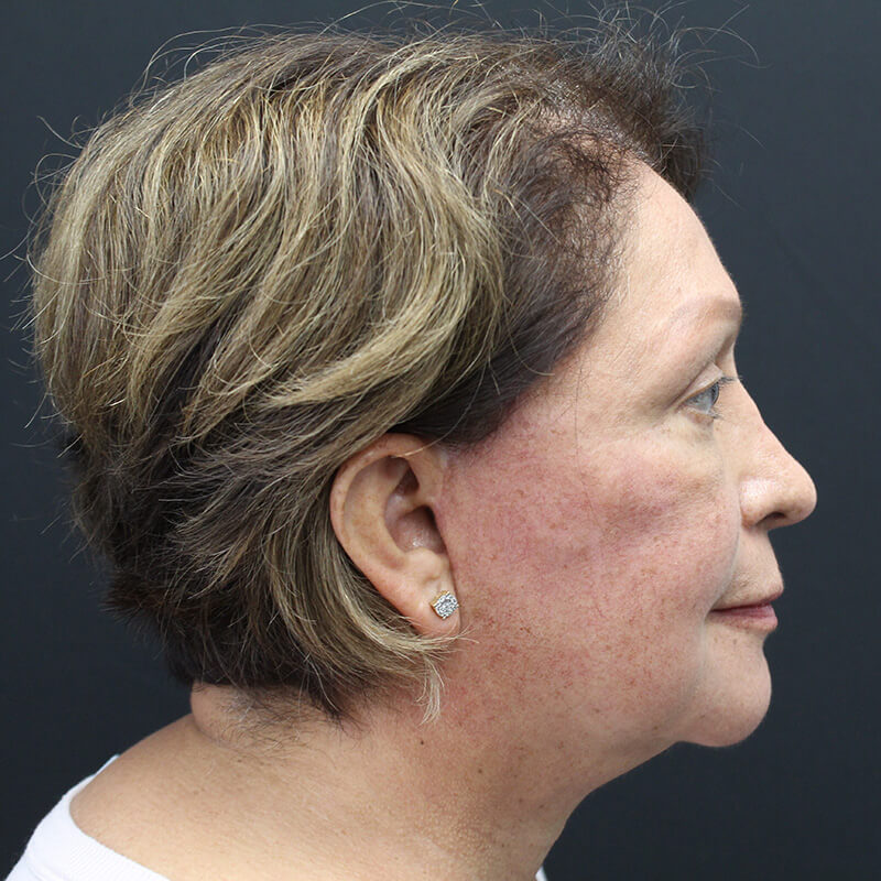 Case--3137 | After Face 3