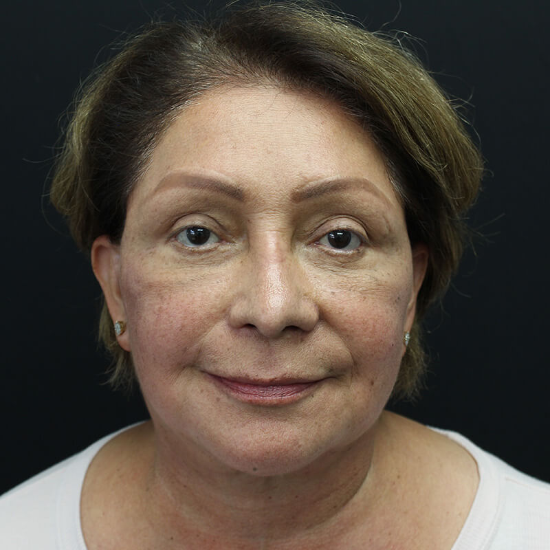 Case--3137 | After Face 1