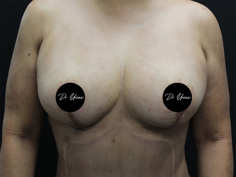 Case--6197 | After Breast Implant Removal w/ Lift & Fat Grafting 1