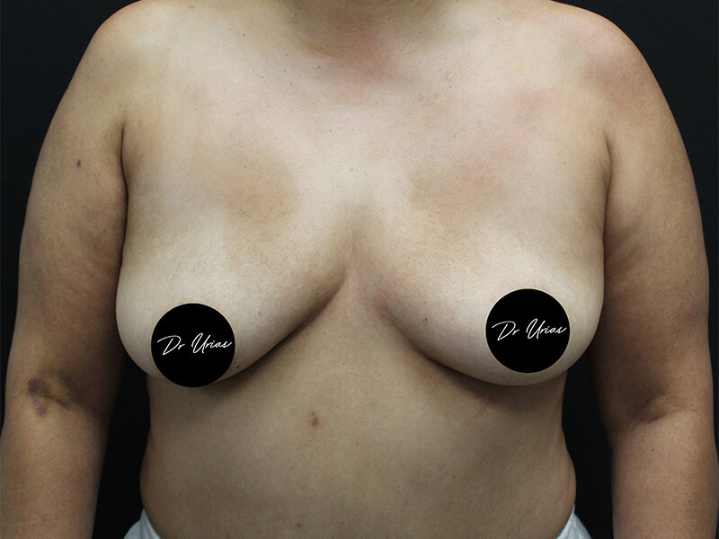 Case--6197 | Before Breast Implant Removal w/ Lift & Fat Grafting 1