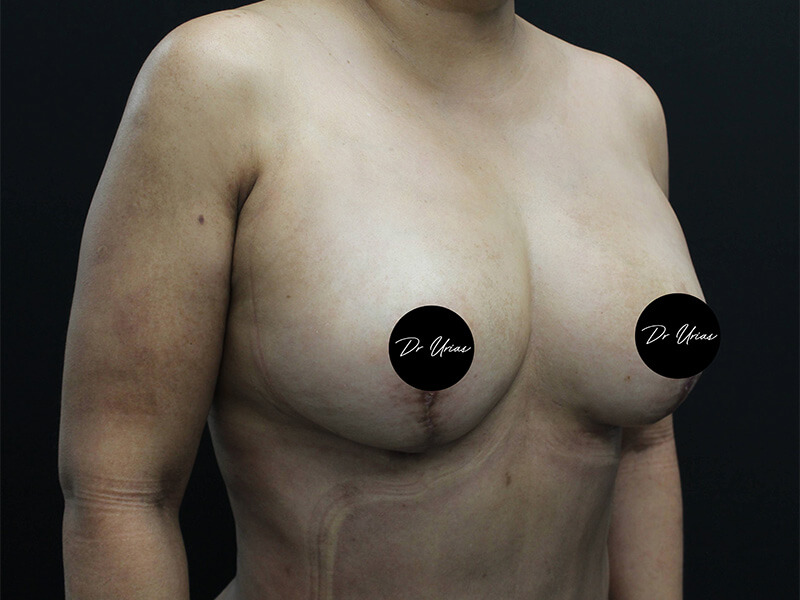 Case--6197 | After Breast Implant Removal w/ Lift & Fat Grafting 2