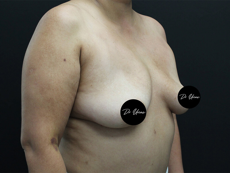Case--6197 | Before Breast Implant Removal w/ Lift & Fat Grafting 2